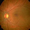 ocular fundus