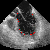 echocardiogram